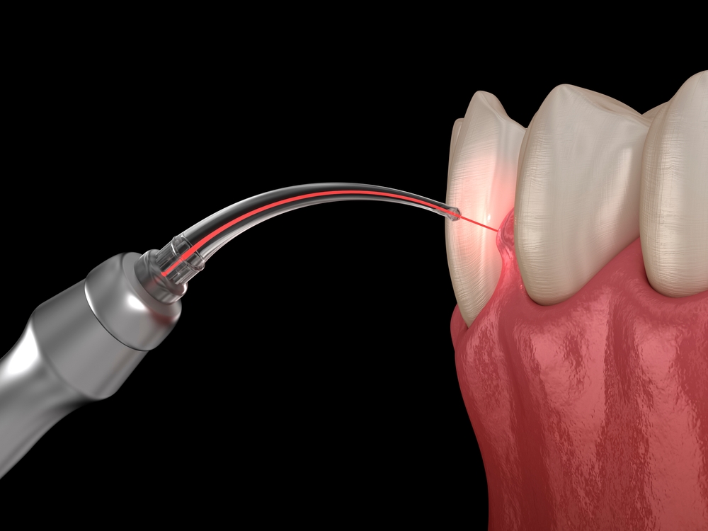 laser dentistry Kingsport